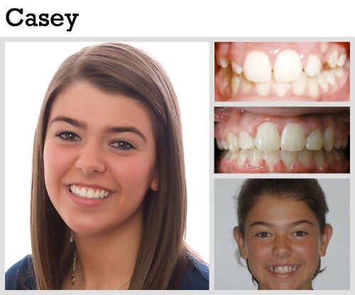 Before & After Patient Photos | Pavlo Orthodontics