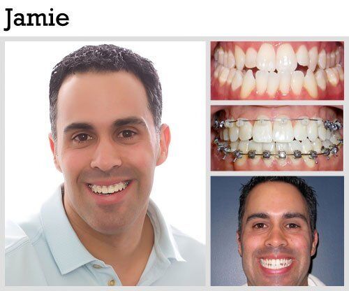 Before & After Patient Photos | Pavlo Orthodontics