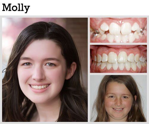 Before & After Patient Photos | Pavlo Orthodontics