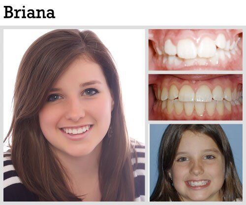 Before & After Patient Photos | Pavlo Orthodontics