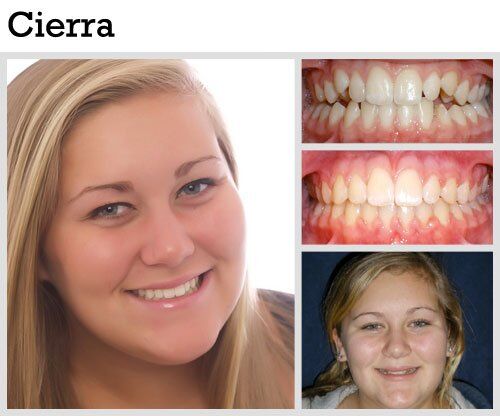 Before & After Patient Photos | Pavlo Orthodontics