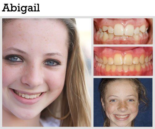 Before & After Patient Photos | Pavlo Orthodontics