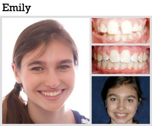 Before & After Patient Photos | Pavlo Orthodontics