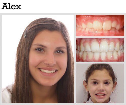 Before & After Patient Photos | Pavlo Orthodontics