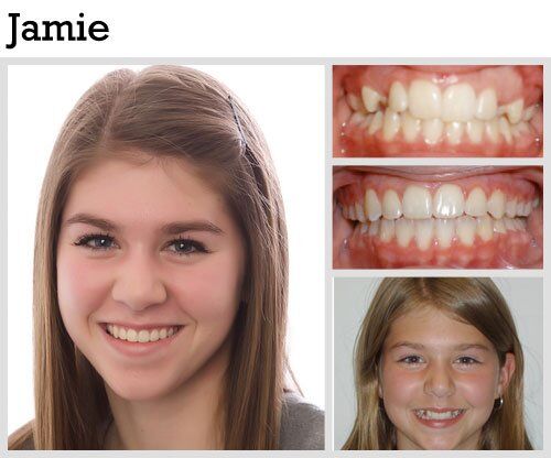 Before & After Patient Photos | Pavlo Orthodontics