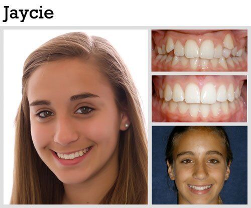 Before & After Patient Photos | Pavlo Orthodontics