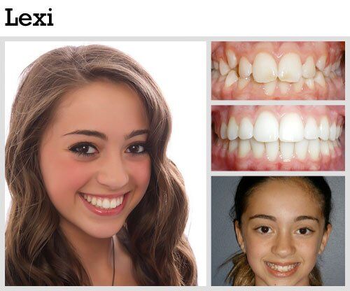 Before & After Patient Photos | Pavlo Orthodontics