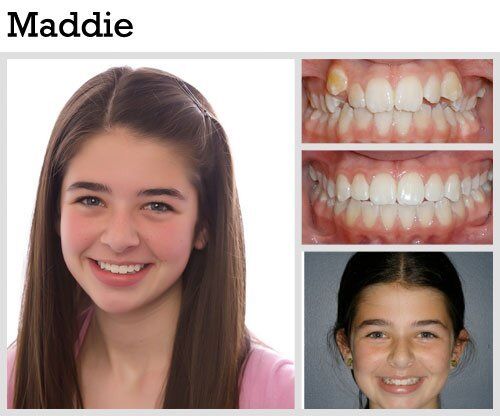 Before & After Patient Photos | Pavlo Orthodontics
