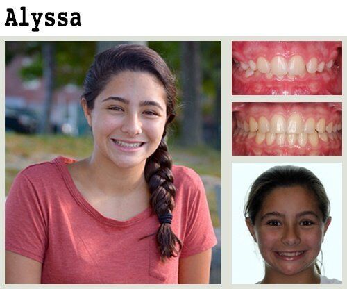 Before & After Patient Photos | Pavlo Orthodontics