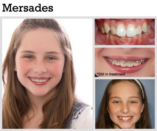 Before & After Patient Photos | Pavlo Orthodontics
