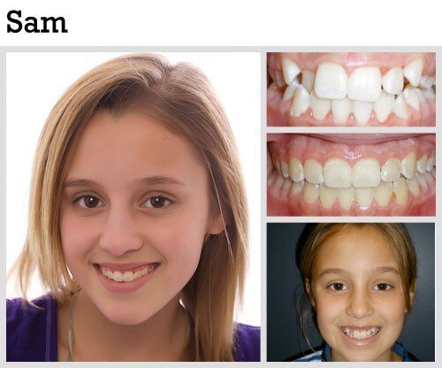 Before & After Patient Photos | Pavlo Orthodontics
