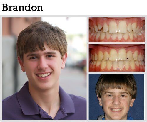 Before & After Patient Photos | Pavlo Orthodontics