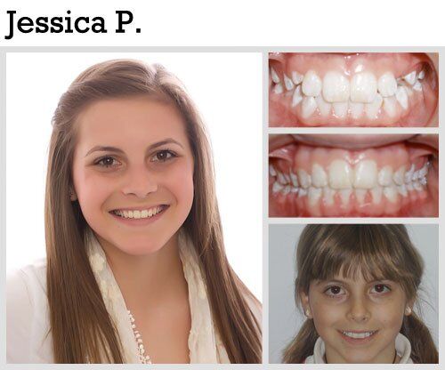 Before & After Patient Photos | Pavlo Orthodontics