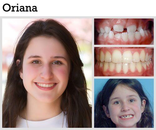 Before & After Patient Photos | Pavlo Orthodontics