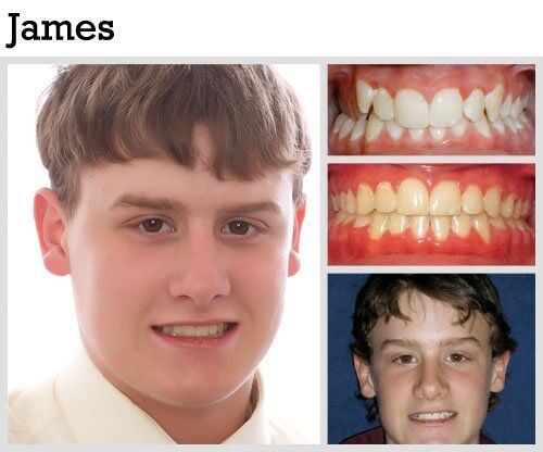 Before & After Patient Photos | Pavlo Orthodontics