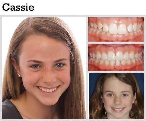 Before & After Patient Photos | Pavlo Orthodontics