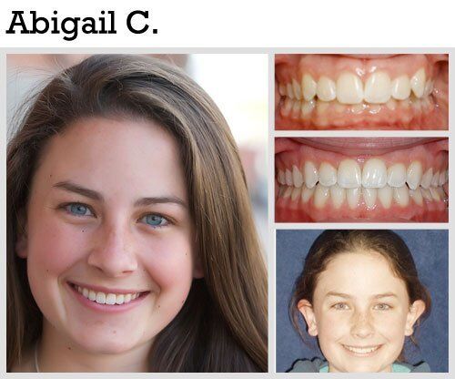 Before & After Patient Photos | Pavlo Orthodontics