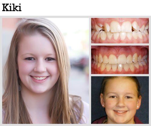 Before & After Patient Photos | Pavlo Orthodontics
