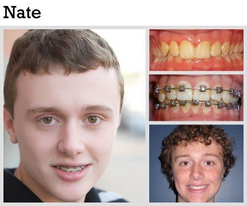 Before & After Patient Photos | Pavlo Orthodontics
