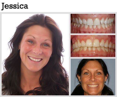 Before & After Patient Photos | Pavlo Orthodontics