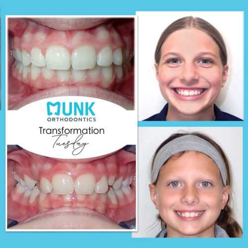 Transformation Tuesday - Munk Orthodontics Patient