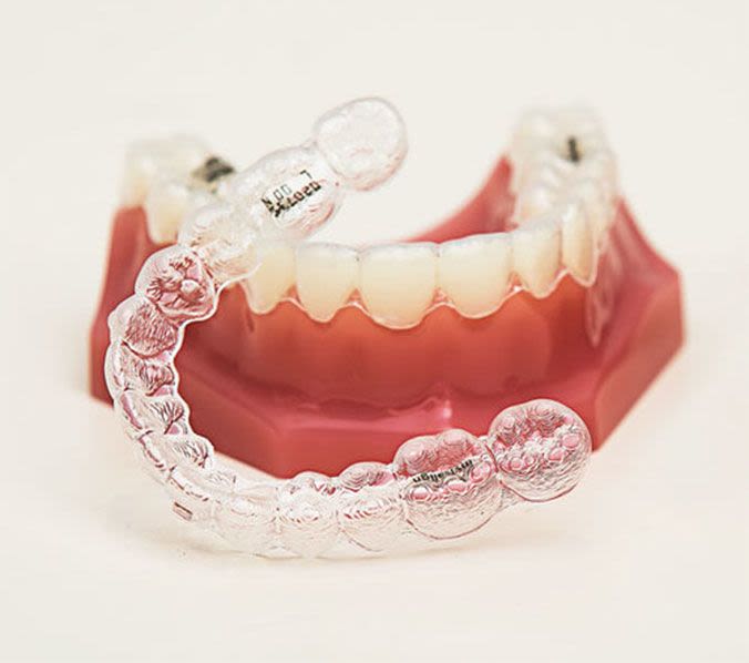 Straighten Your Smile Without Braces